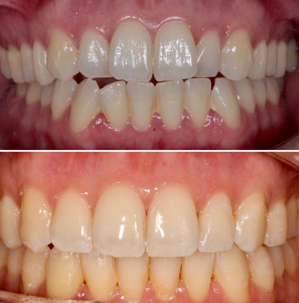 Ortodontia Invisalign – Clínica Fatarelli Odontologia Integrada