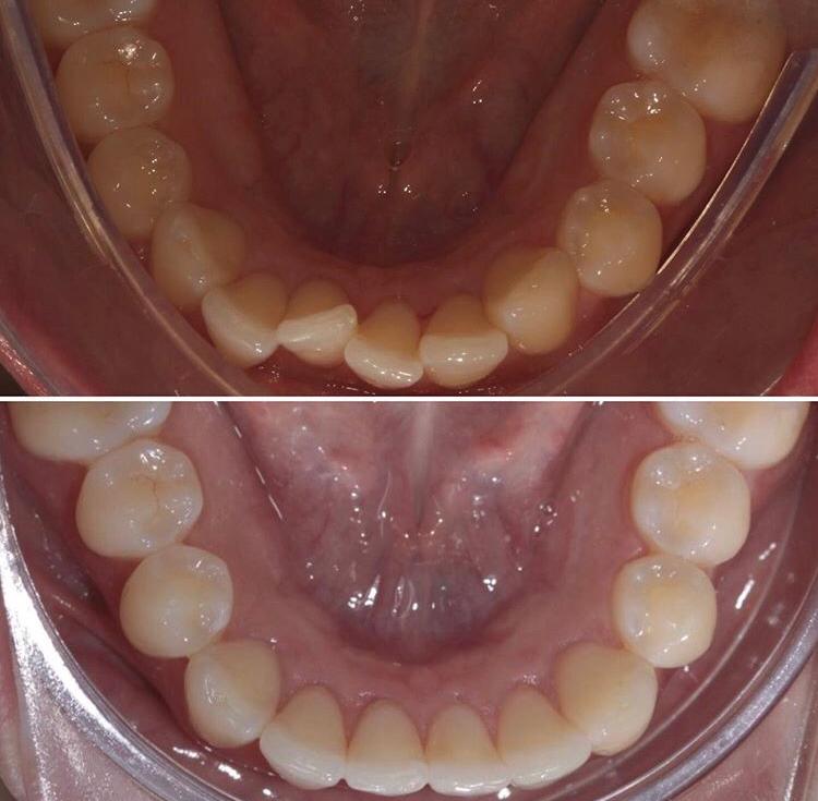 O Tratamento com Invisalign é indicado para todos os pacientes que precisam  corrigir a posição dos dentes e ou a estética do sorriso. - COI