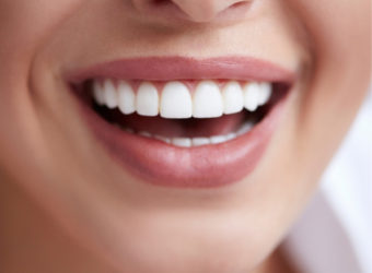 Qual a diferença entre faceta e lente de contato dental?