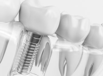 Por que colocar implantes dentários?